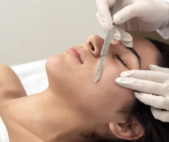Dermaplaning results at Zahav Medspa, Scottsdale AZ